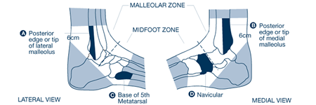 Ankle Injury - X-Ray for Acute Injury of the Ankle or Mid-Foot ...