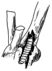 Drawing of a crown borer